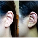 Left: Untouched ear; Right: Ear used for cartilage transfer to nose, 6 days post op.