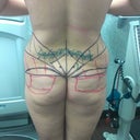 Before flank lipo and fat grafting