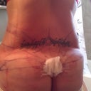 I day post op, really swollen but much curvier!
