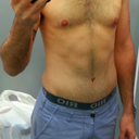 Post Op - 3 months