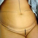 Dr markings of what was getting cut off! 5 POUNDS of skin!!