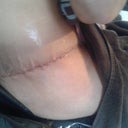 2 days post op