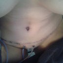 2 days post op