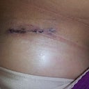 2 week incision left breast (under crease)
