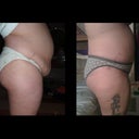 pre op and 2 weeks post op