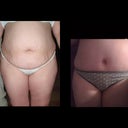 pre op and 2 weeks post op