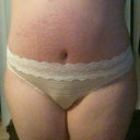These are all the new stretch marks 6 weeks post op