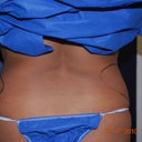 Back shot before surgery