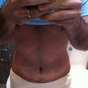 Post Op - Day 5 - Getting better every day.