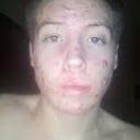 2nd week accutane.