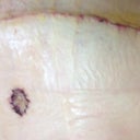 4 day post op