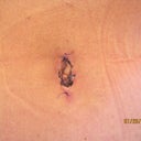 12 days po Belly Button - what in the world is going on with this nonsense?  will it ever look like a real bb?