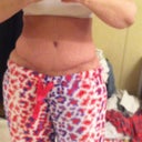 6 weeks post op