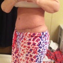 6 weeks post op