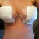Day 1 before gauze was removed.