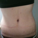 11 weeks post op