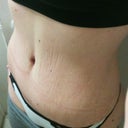 11 weeks post op.