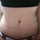 11 weeks post op
