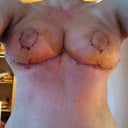 7 days post-op. Still bruised and swollen...