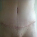 Tummy incision, 6 weeks