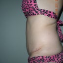 Side view 7 months post op