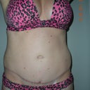 front view 7 months post op