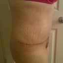 Post Op 7 weeks
standing straight and happy my V-JayJay and tummy is flat!
(CG marks - taken in the morning before the swelling begins)