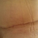 Post Op 7 weeks
close up of scar (CG marks! lol)