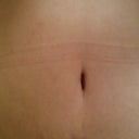 Post Op 7 weeks
BB stitches were done from the inside so no scars!