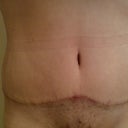 Post Op 7 weeks
Scar is starting to turn red (I hear one of the stages of scar healing...)