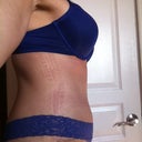 Day 10 Post Op (My Buddha belly)