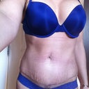Day 10 Post Op (the scar)