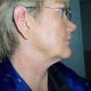 BEFORE SIDE VIEW