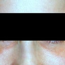 This is two months out but before any IPL treatments for the redness left by the Radiesse.