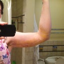 Day 14 post-op; tape is gone!