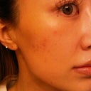 3 days after, with light makeup on...some improvement?