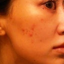 5 days after, no makeup...skin has new breakouts:(