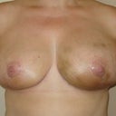 12 days Post-Op