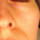 In this image I would like to draw attention to the patch of hypopigmentation underneath my eye. It is even shaped in the form of the head of the IPL.