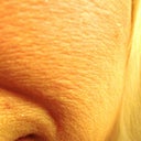 As you can clearly see, this picture, taken about a year and a half after my last IPL treatment, demonstrates that the damage intensifies as time progresses.