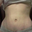 4weeks in my underwear. Can see part of scar at the midpoint where it's slightly higher