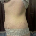 Soooooooo swollen. Left side. 4weeks post op.