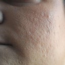 Day 8, swelling has gone down completely and my scars/large pores are still there 100%.  Oh and I have makeup on, so my face is still reddish underneath.