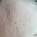 Day 8, swelling has gone down completely and my scars/large pores are still there 100%.  Oh and I have makeup on, so my face is still reddish underneath.