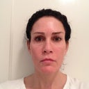 This is two weeks post my treatment, and I am already notice a difference.