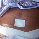 2 days post op on the flat side
