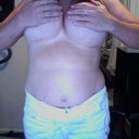 This is a pic of my scars you cant see them! They are small less then an inch and clear already! super great job!!
7 months after surge-- 640cc & 660 cc High profile implants Sub glandular (about muscle) Scar is under my breast.