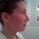 OMG minutes after taking the cast off!! Wow bump is gone!