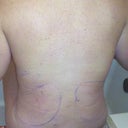 Post-op Day 2, backside. Minimal bruising from the flank lipo.