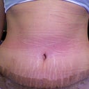 2 weeks post opp....NO DRAINS!!!